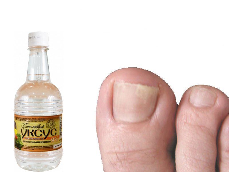 Грибок ногтей препараты отзывы чем лечить. Народные средства от грибка ногтей. Излечение грибка ногтей.