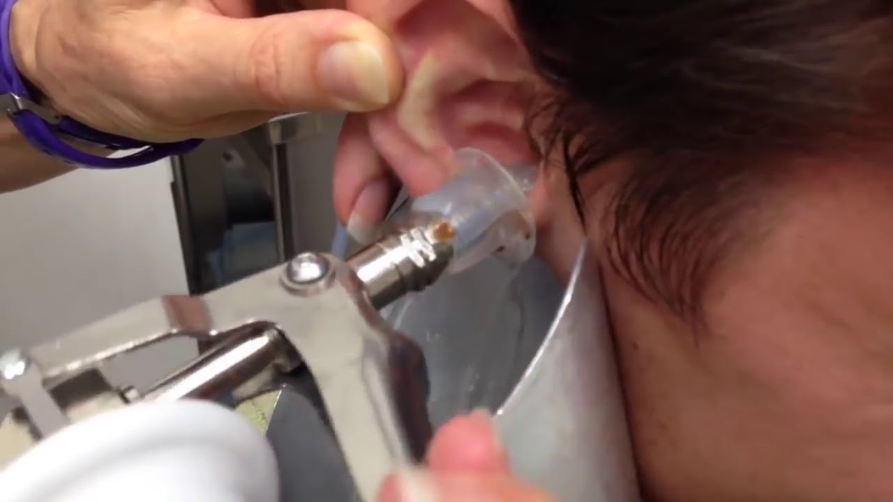 Ирригатором промыть уши можно процедура отбеливание зубов ее цена