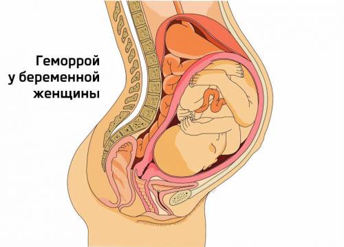 Геморрой при беременности