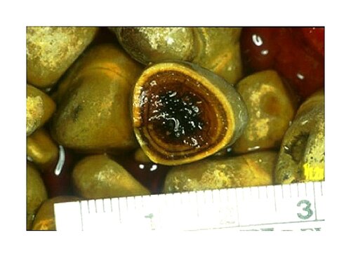 gallbladder mixed stone.jpg