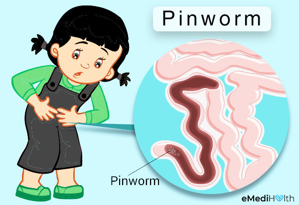 Pinworms diagram