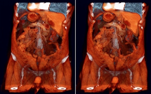 томография желудка