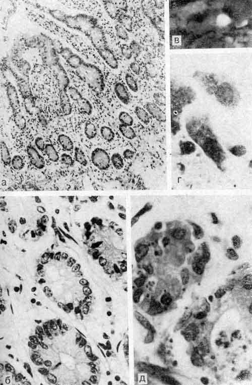 Гистологические изменения стенки тонкой кишки при аденовирусной инфекции