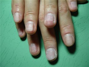 Восстановление ногтей