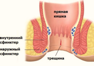 больно тужиться по-большому фото