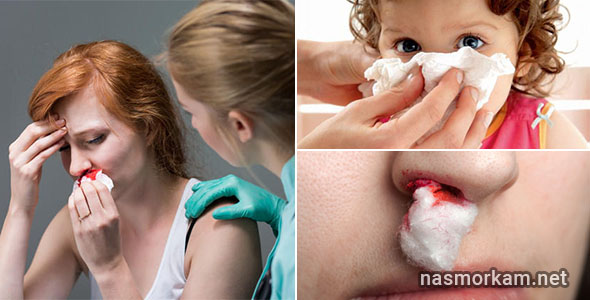 Из носа сгустки крови: причины. Почему образуются? Методы терапии
