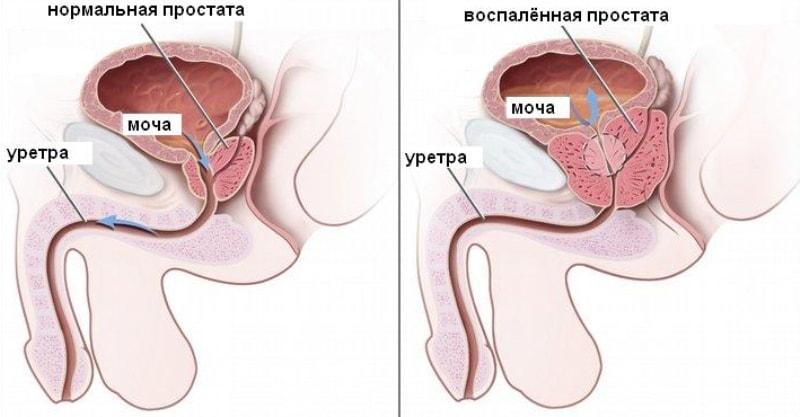 Нормальная и воспаленная простата