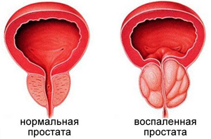 простатит