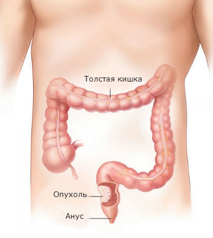 Рак толстой кишки