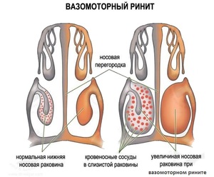 Проявление вазомоторного ринита