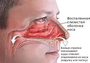 Как лечить воспаленную слизистую носа