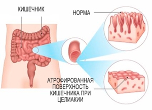 Причины развития целиакии