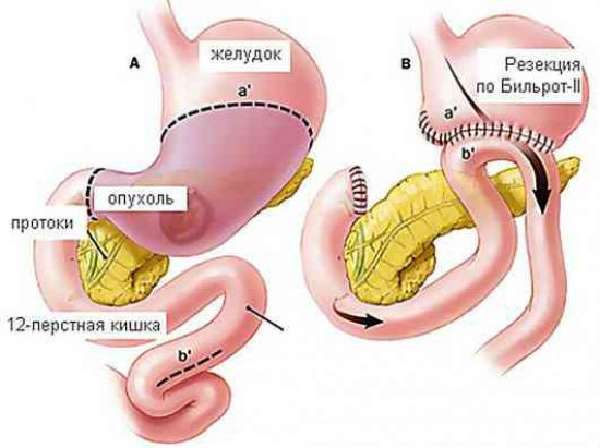 Операции желудка