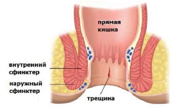 Трещины прямой кишки