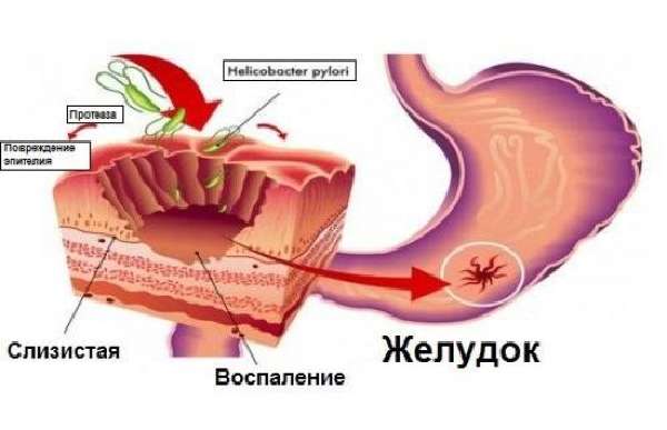 Хеликобактер пилори в желудке