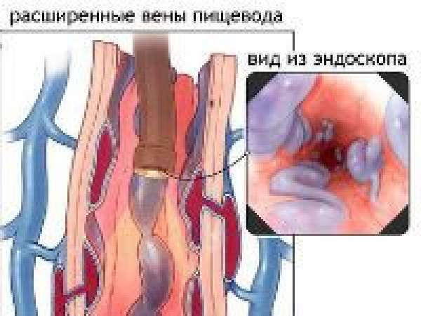 Варикоз вен пищевода