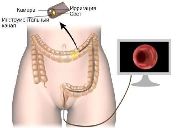 Колоноскопия