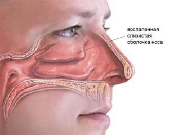 Причины болевого синдрома при насморке