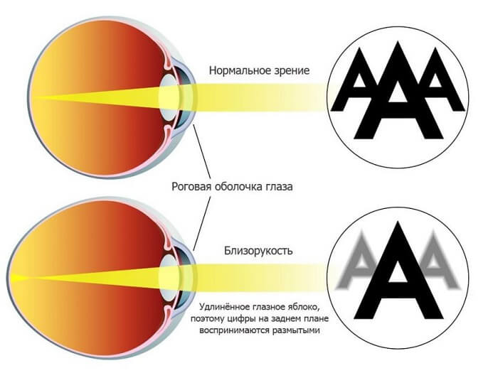 Зрение человека при близорукости