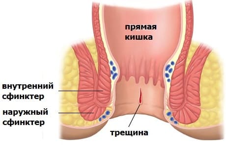 Кровь в кале (стуле), кровотечение из заднего прохода (прямой кишки, ануса)