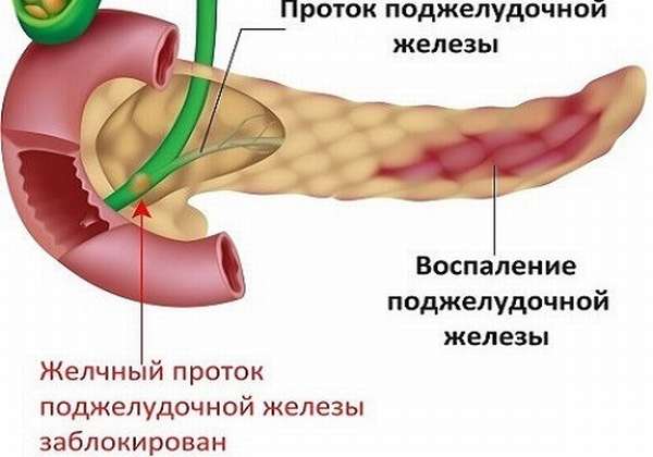 Панкреатит