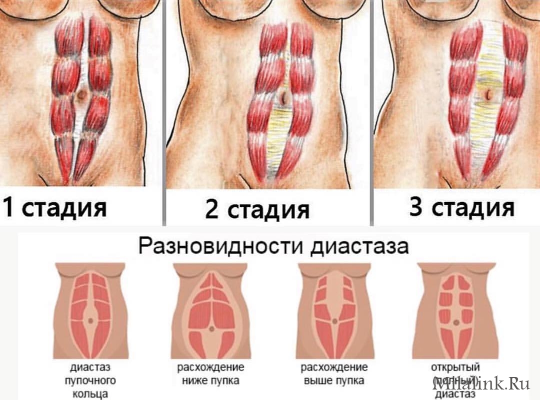 Что такое диастаз, как его распознать и что делать