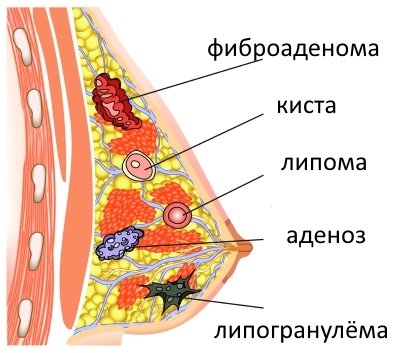 шишки в груди