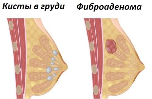 шишки в груди