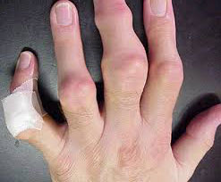 Пальцы при заболевании подагрой