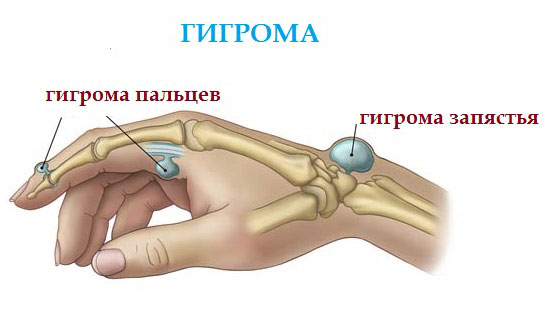 Гигрома на руке