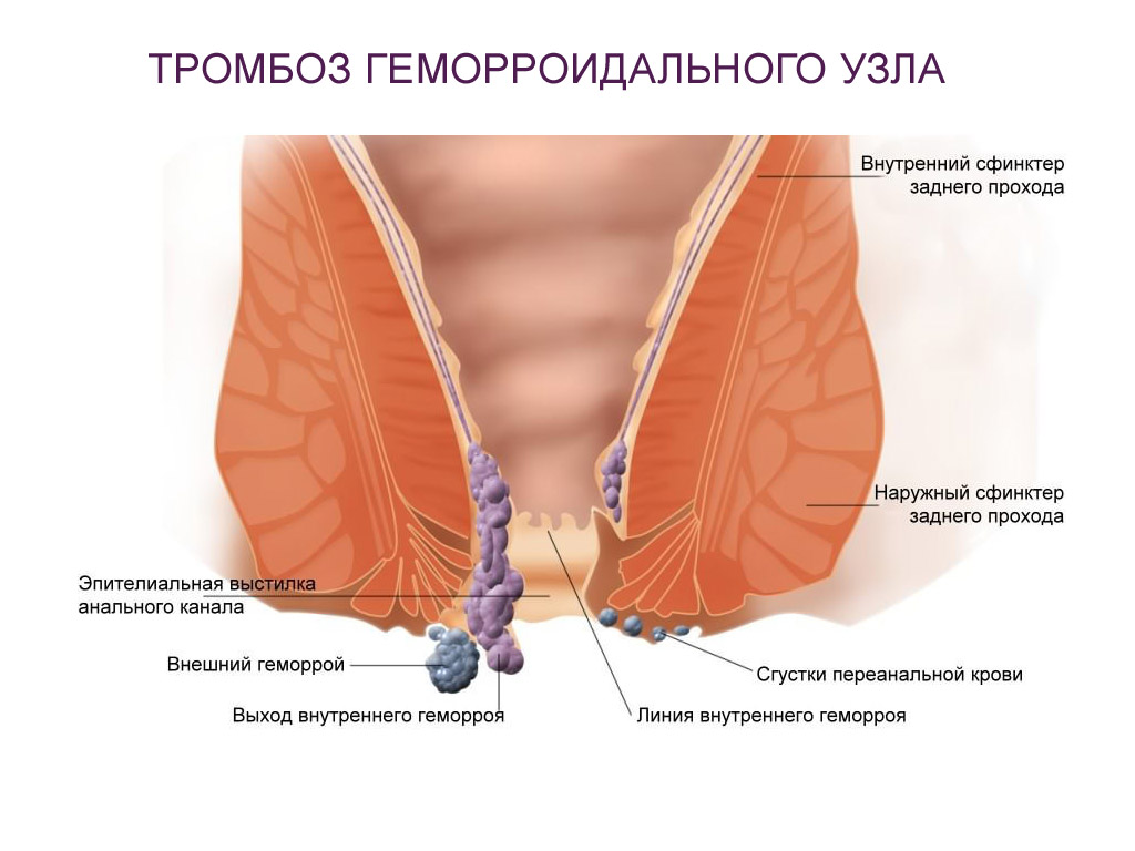Тромбоз возникает при отеках слизистой оболочки прямой кишки