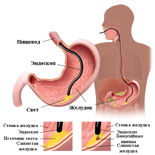 Процедура гастроскопии