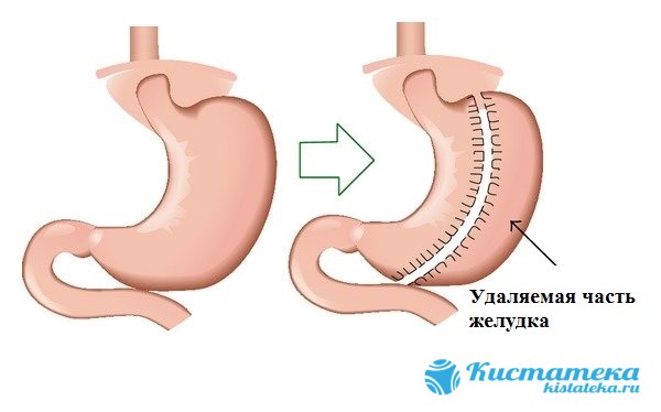 В процессе проведения гастрэктомии полностью удаляется желудок