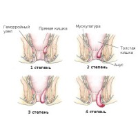 Схема демонстрирует 4 степени геморроя