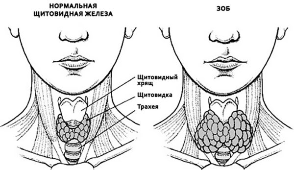 зоб лечение народными средствами