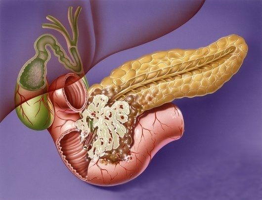Рак поджелудочной железы