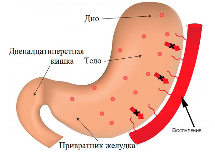 Антральный эрозивный гастрит желудка