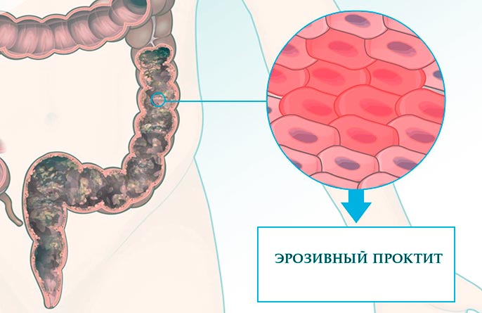 Хронический эрозивный проктит