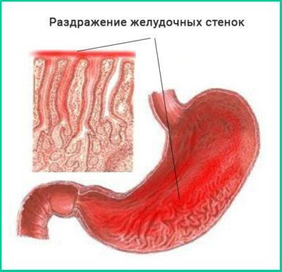 Хронический гипертрофический гастрит желудка