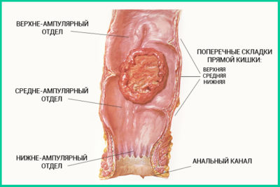 Нейроэндокринная опухоль прямой кишки
