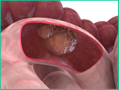 Раковая опухоль прямой кишки