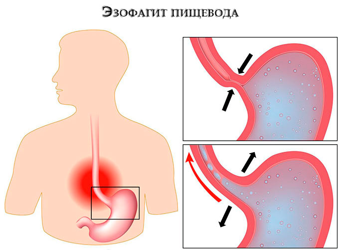 Рефлюкс эзофагит пищевода