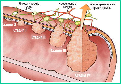 Опухоль прямой кишки 1-2-3-4 стадия