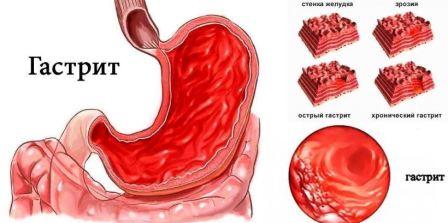 Молоко при гастрите 