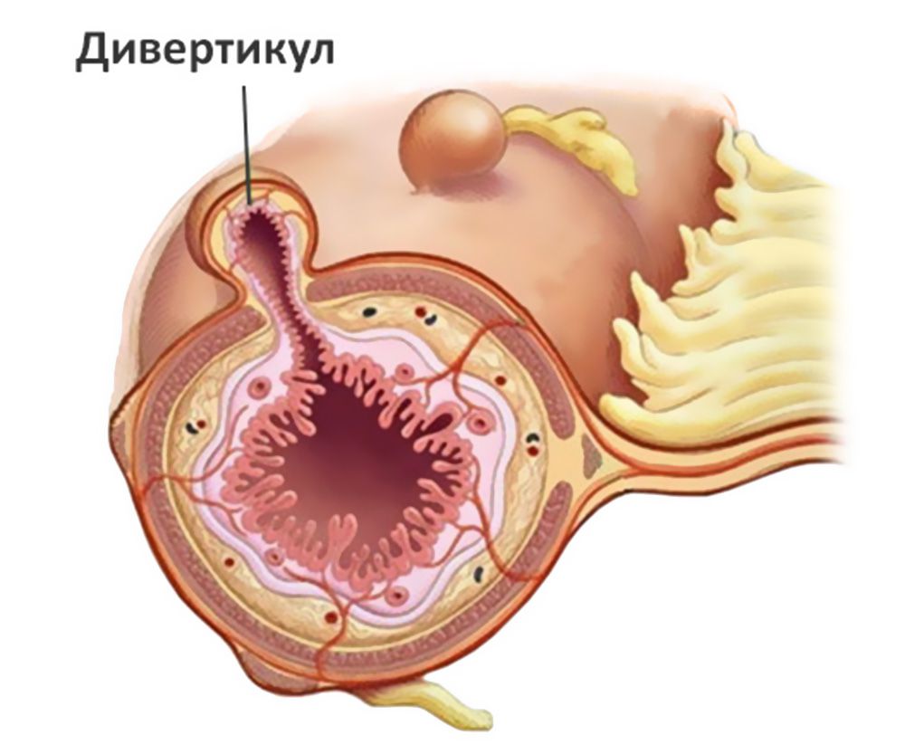 Дивертикулез кишечника: симптомы, диета и питание