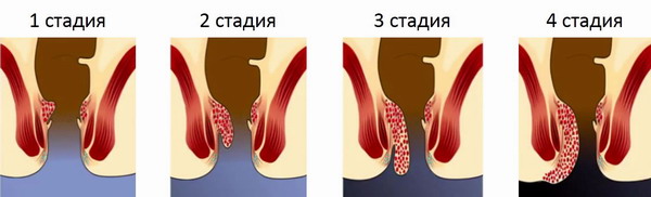 стадии геморроя