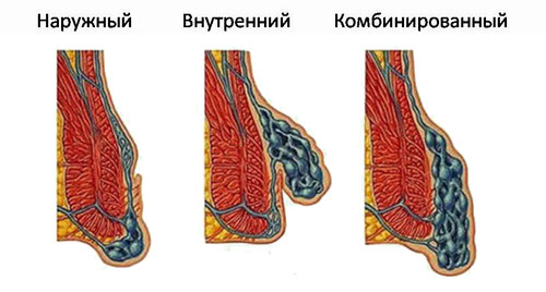 виды геморроя