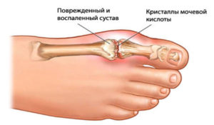 Повреждение сустава при подагре