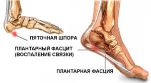 Локализация плантарной фасции, фасциита и шпоры