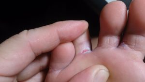 Трещины между пальцами ног